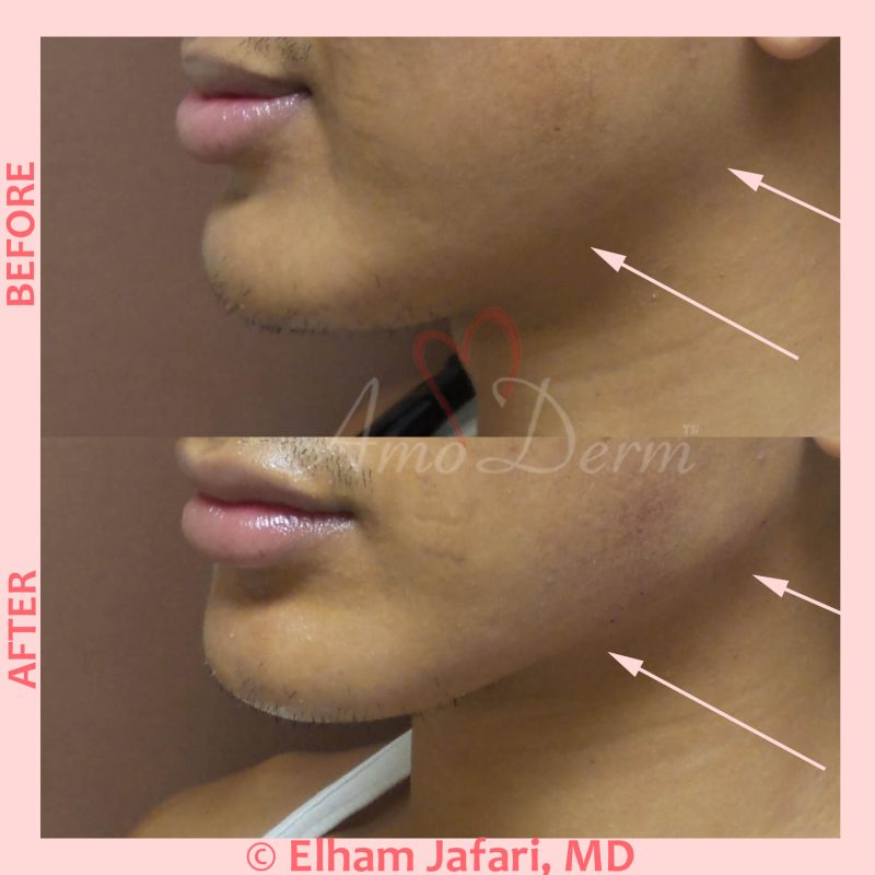 Jawline contouring and restoration with fillers