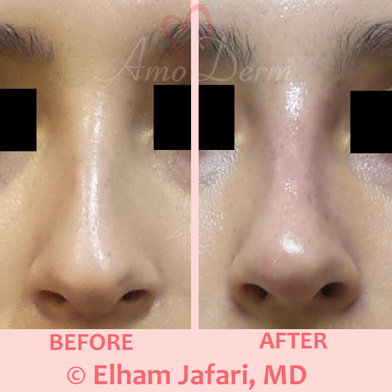 Non Surgical Nose Job What Is A Liquid Nose Job And How Do They Work Images