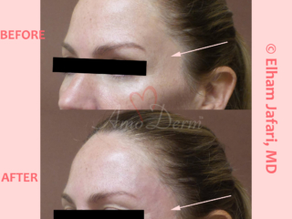 Volume restoration in temples with filler injection (Juvederm, Restylane, Voluma, Sculptra)