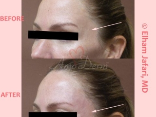 Volume restoration in temples with filler injection (Juvederm, Restylane, Voluma, Sculptra)
