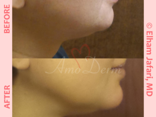Non surgical reduction of double chin with Kybella &amp; Chin augmentation with filler injection (Voluma, Bellafill, Radiesse)