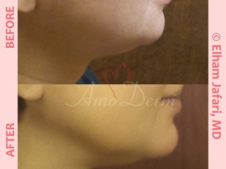 Non surgical reduction of double chin with Kybella &amp; Chin augmentation with filler injection (Voluma, Bellafill, Radiesse)