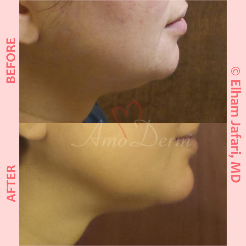 Non surgical reduction of double chin with Kybella &amp; Chin augmentation with filler injection (Voluma, Bellafill, Radiesse)