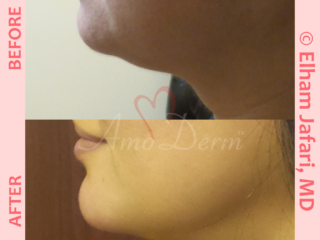 Non surgical reduction of double chin with Kybella &amp; Chin augmentation with filler injection (Voluma, Bellafill, Radiesse)
