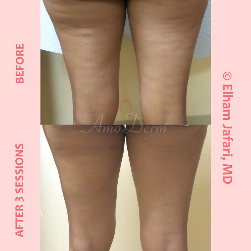 Skin tightening and cellulite treatment with Venus Freeze (radiofrequency)