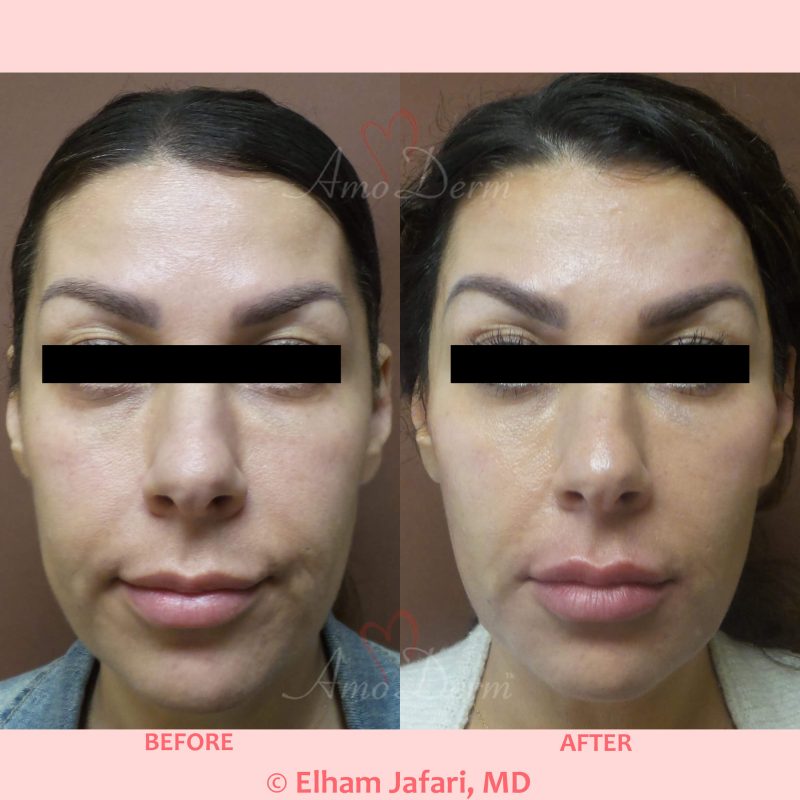 Liquid Facelift with filler injection in temples, cheeks, nasolabial filds, Marionette lines &amp; lips
