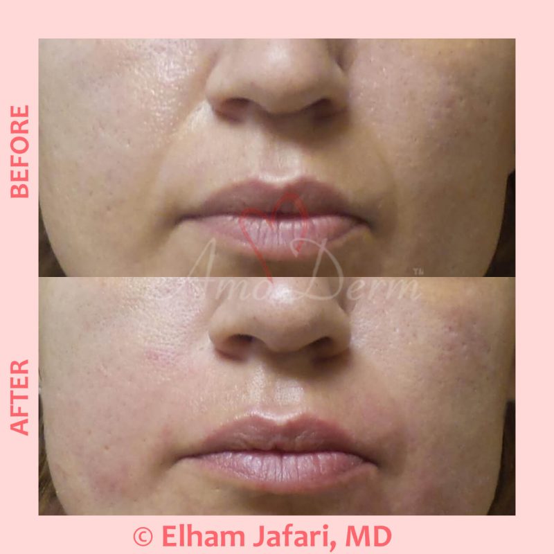 Treatment of nasolabial folds as part of non-surgical facelift
