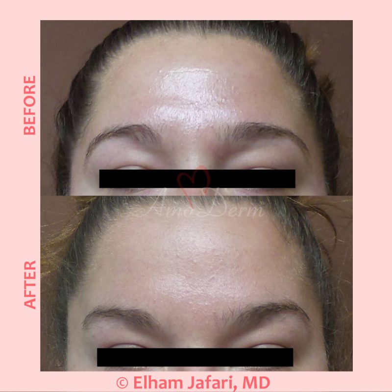 Non-surgical brow lift and treatment of lines in forehead with Botox Non-surgical brow lift and treatment of lines in forehead with Botox