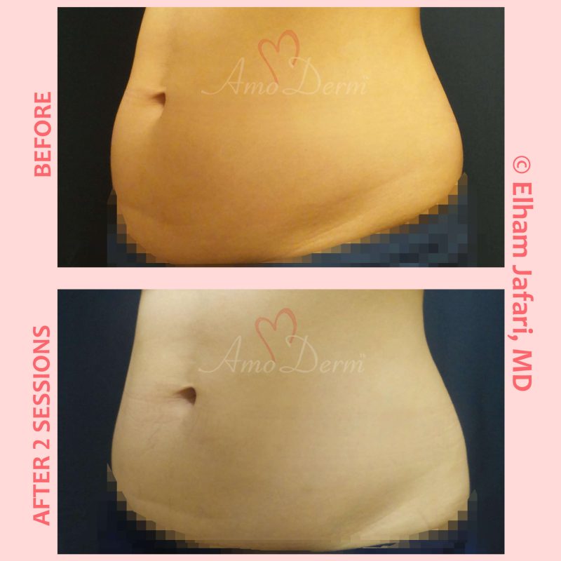 SculpSure Stubborn Fat Reduction