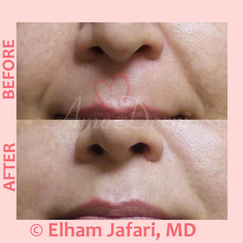 Treatment of nasolabial folds as part of non-surgical facelift