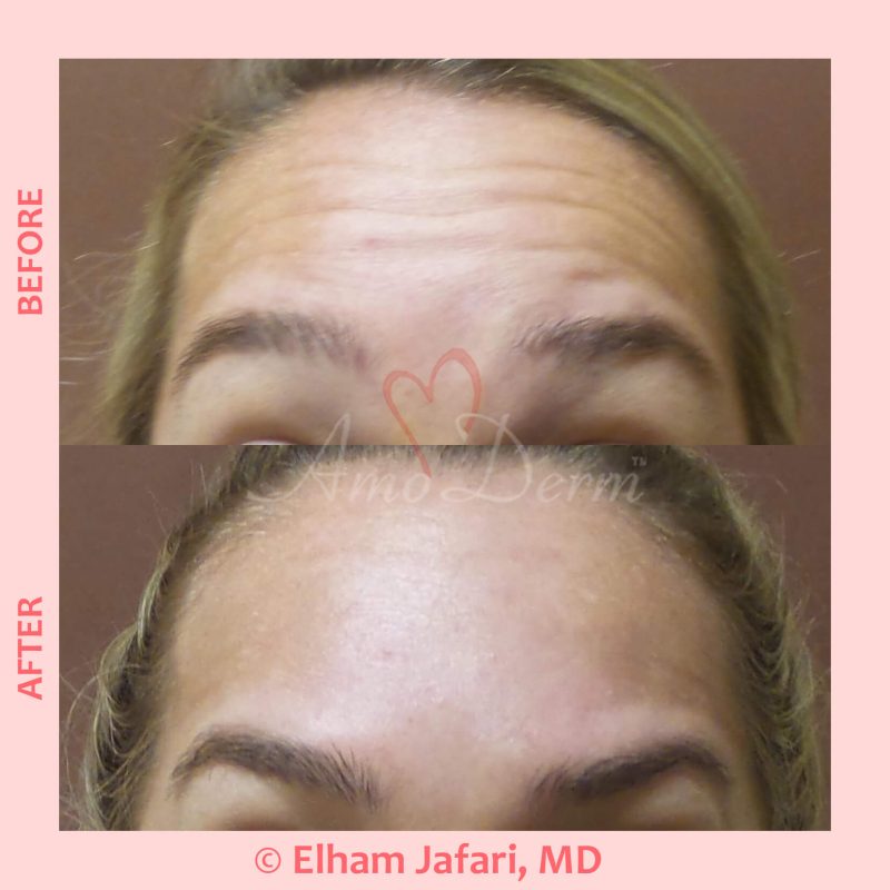 Cosmetic treatments with Botox injection Botox injection for treatment of lines and wrinkles in forehead, glabella & frown lines
