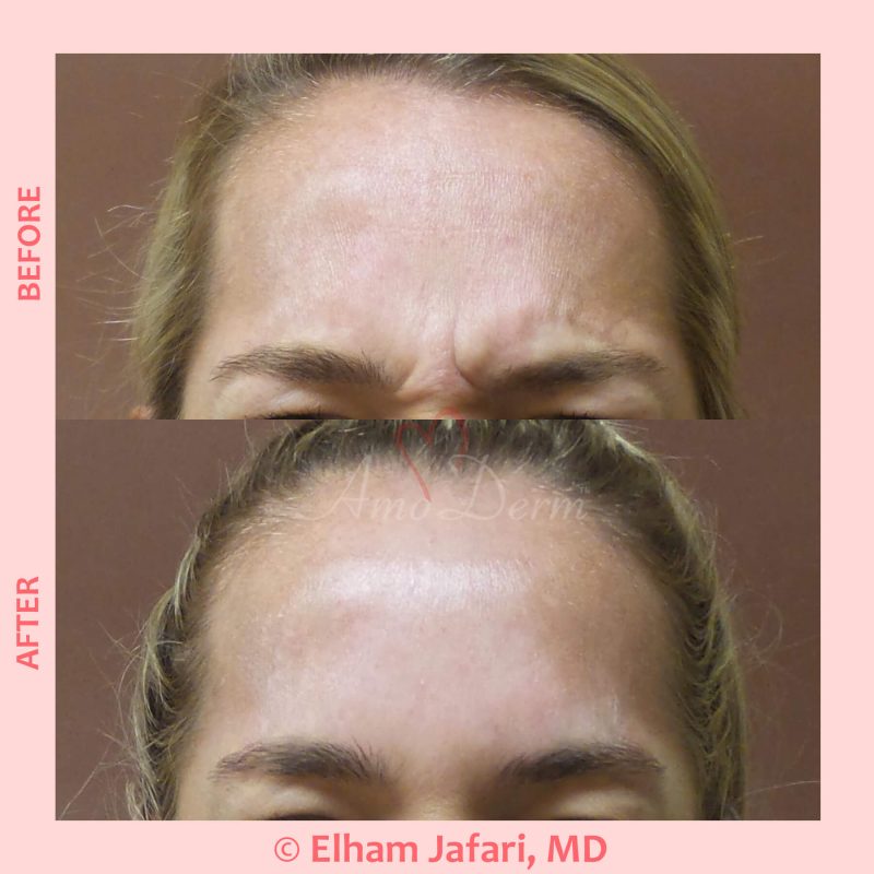 Cosmetic treatments with Botox injection Botox injection for treatment of lines and wrinkles in forehead, glabella & frown lines