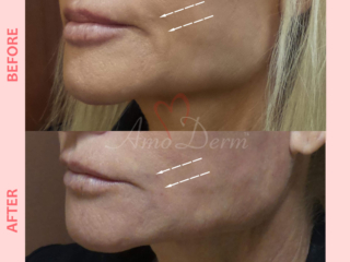 PDO Thread Lift for treatment of nasolabial folds &amp; marionette lines