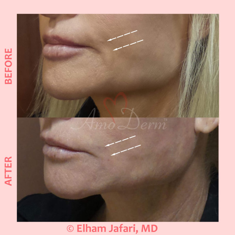 PDO Thread Lift for treatment of nasolabial folds &amp; marionette lines