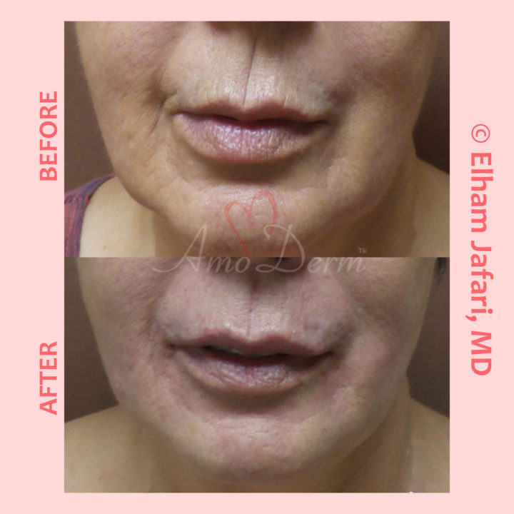 Treatment of Marionette lines and lines at corner and above the mouth and lip augmentation with Juvderm ultra, Volbella, Voluma