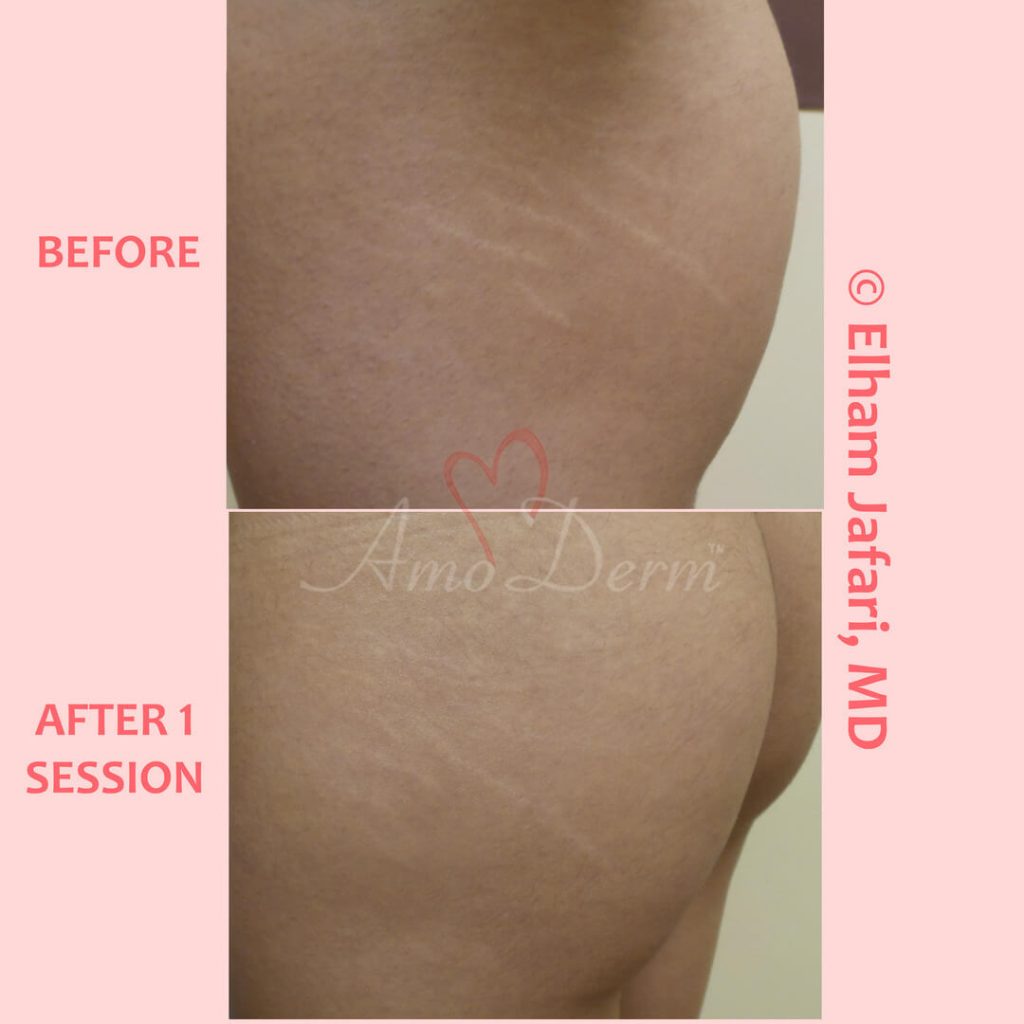 Treatment of stretch marks with Fractional CO2 laser (CO2 laser skin resurfacing)