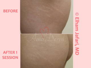 Treatment of stretch marks with Fractional CO2 laser (CO2 laser skin resurfacing)
