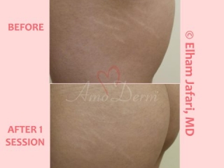 Treatment of stretch marks with Fractional CO2 laser (CO2 laser skin resurfacing)