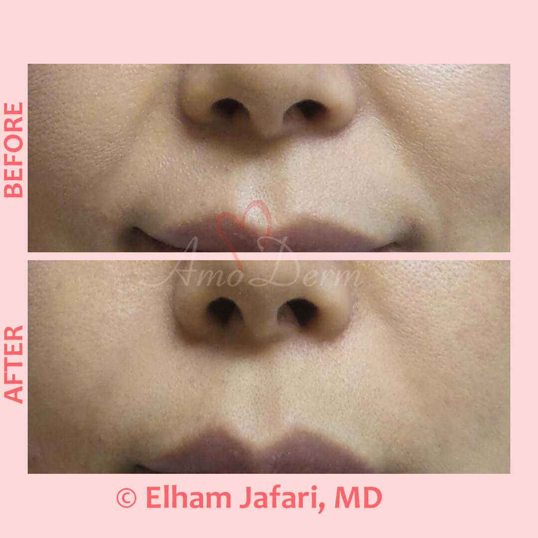 Treatment of nasolabial folds as part of non-surgical facelift