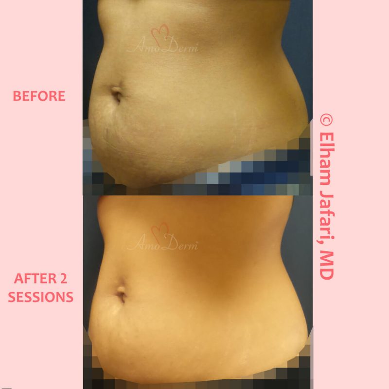 SculpSure Stubborn Fat Reduction