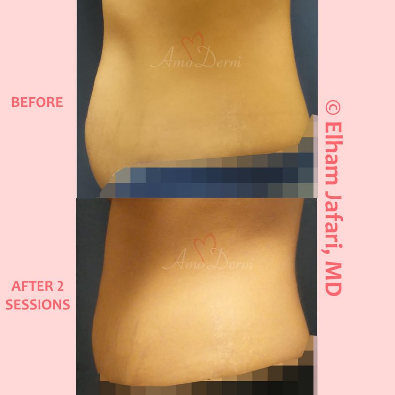 SculpSure Stubborn Fat Reduction