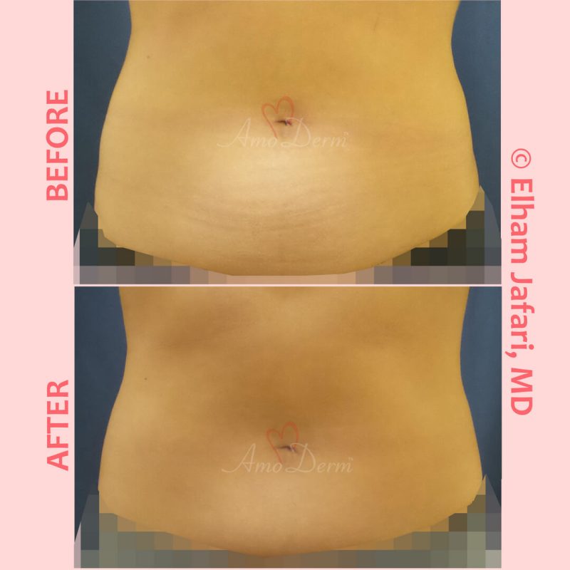 SculpSure Stubborn Fat Reduction