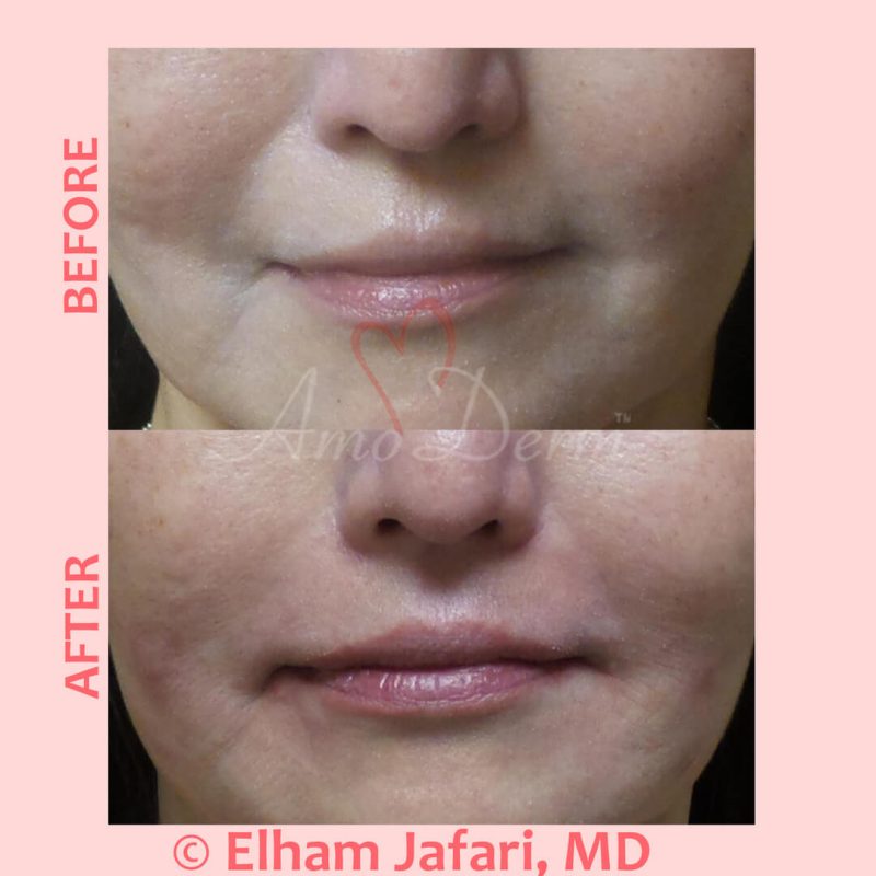 Treatment of nasolabial folds as part of non-surgical facelift