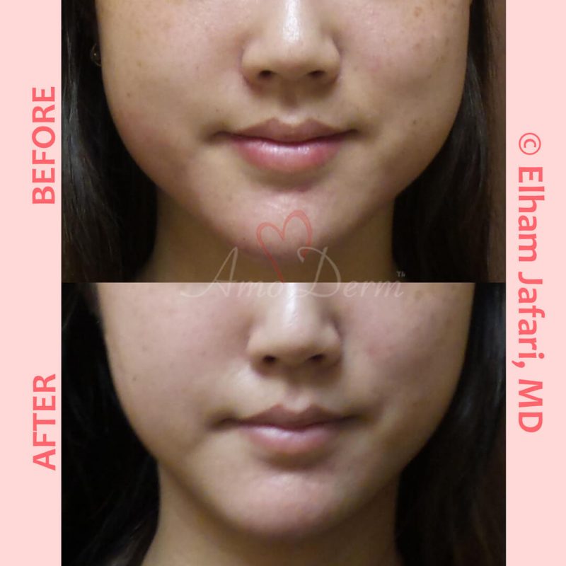 Jaw slimming or Jaw reduction Facial slimming (jaw slimming or jaw reduction) is known as cosmetic facial injection