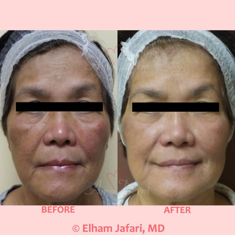 Microlaser Peel - Erbium laser skin resurfacing