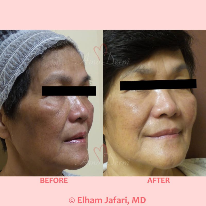 Microlaser Peel - Erbium laser skin resurfacing