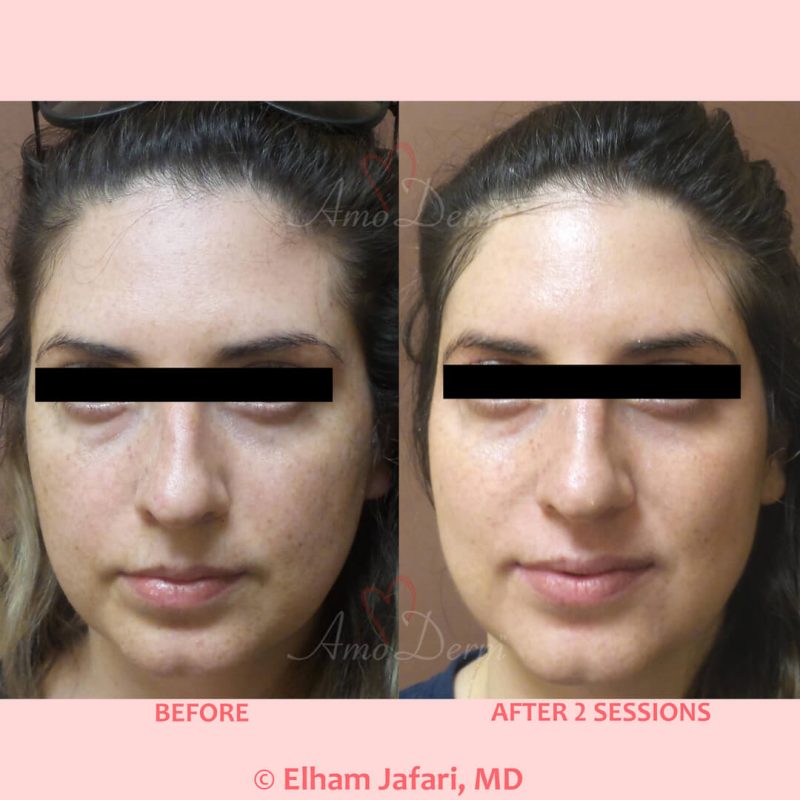 Microlaser Peel - Erbium laser skin resurfacing