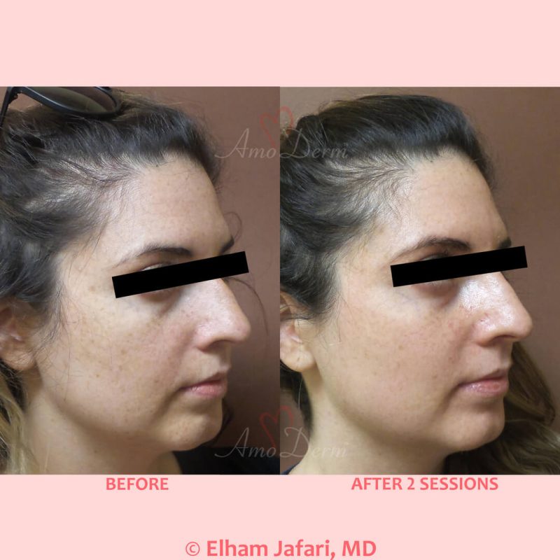 Microlaser Peel - Erbium laser skin resurfacing