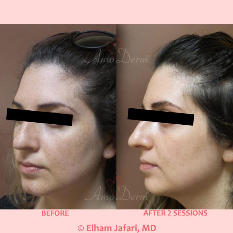 Microlaser Peel - Erbium laser skin resurfacing