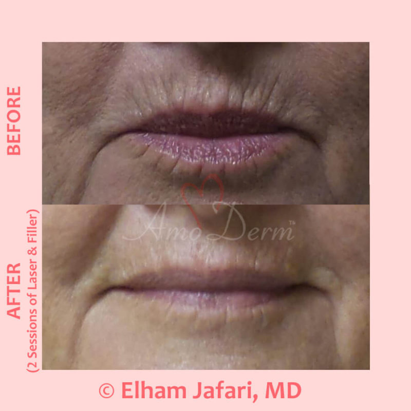 Treatment for smoker&#039;s lines above upper lip with filler injection and Erbium laser