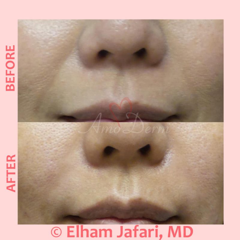 Treatment of nasolabial folds as part of non-surgical facelift