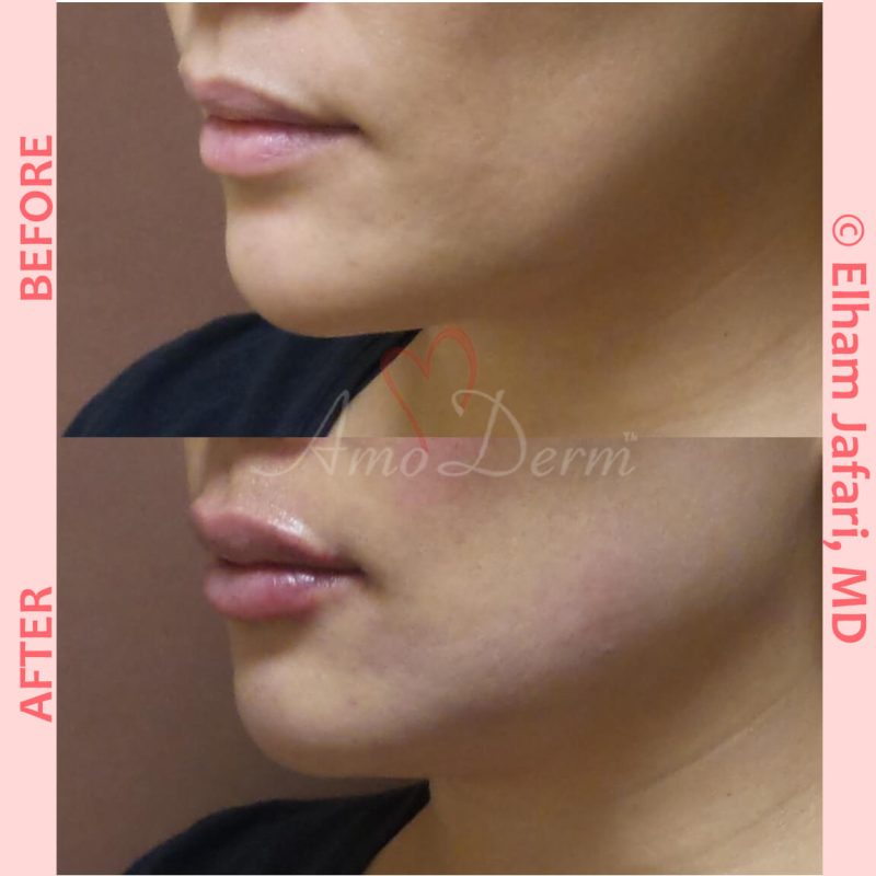 Filler for jawline sculpting and contouring to create a chisled jawline as well as lip augmentation