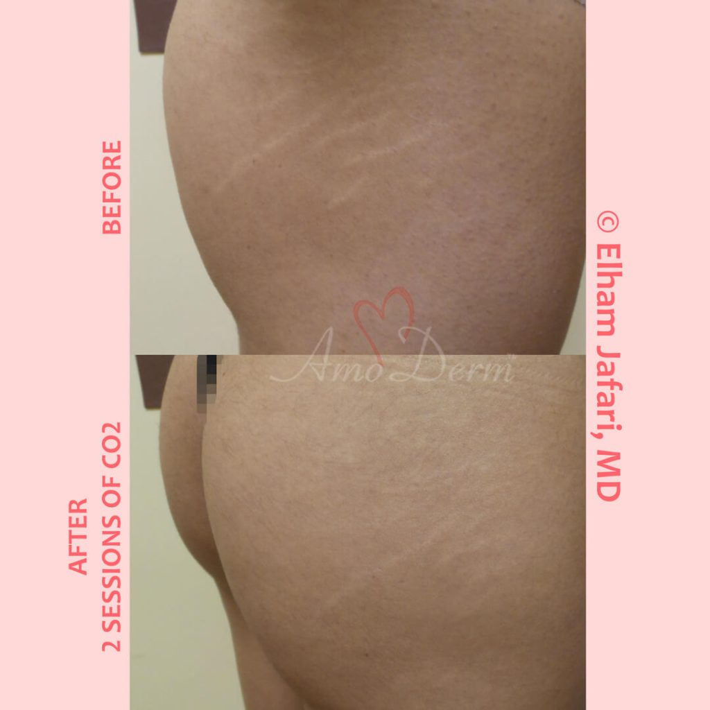 Treatment of stretch marks with Fractional CO2 laser (CO2 laser skin resurfacing)