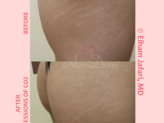 Treatment of stretch marks with Fractional CO2 laser (CO2 laser skin resurfacing)