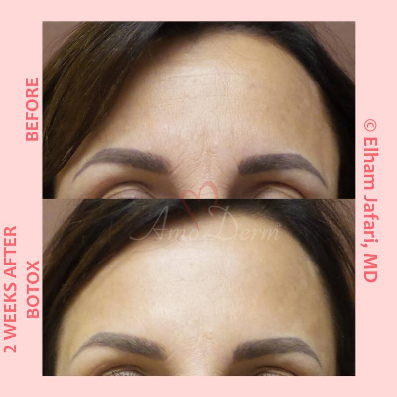 Cosmetic treatments with Botox injection Botox injection for treatment of lines and wrinkles in forehead, glabella & frown lines