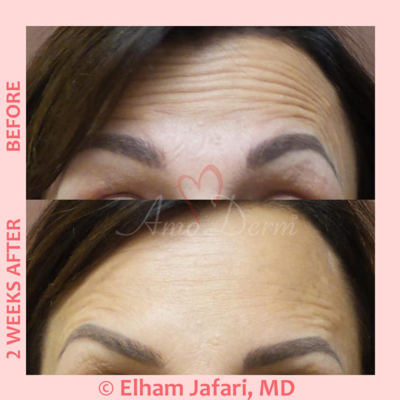 Cosmetic treatments with Botox injection Botox injection for treatment of lines and wrinkles in forehead, glabella & frown lines