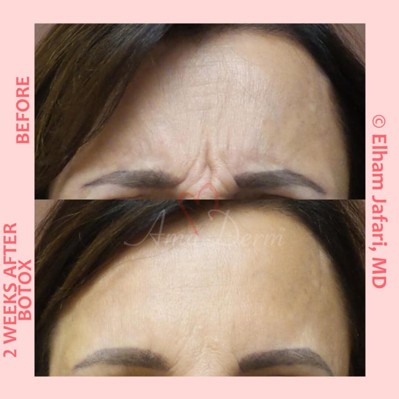 Cosmetic treatments with Botox injection Botox injection for treatment of lines and wrinkles in forehead, glabella & frown lines