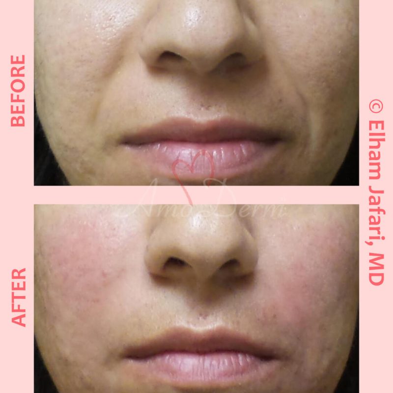 Treatment of nasolabial folds as part of non-surgical facelift