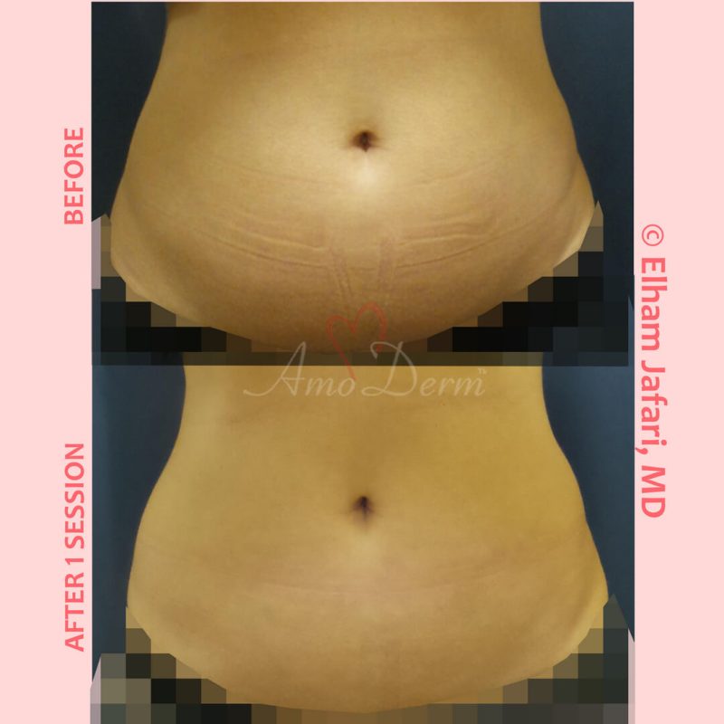 SculpSure Stubborn Fat Reduction