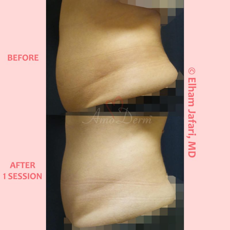SculpSure Stubborn Fat Reduction
