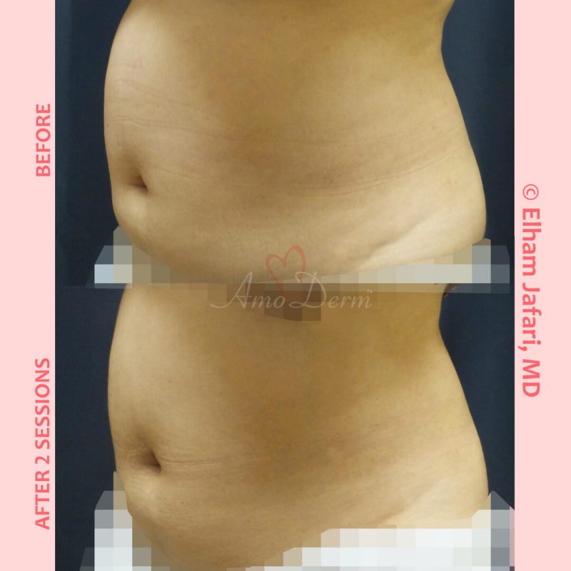 SculpSure Stubborn Fat Reduction