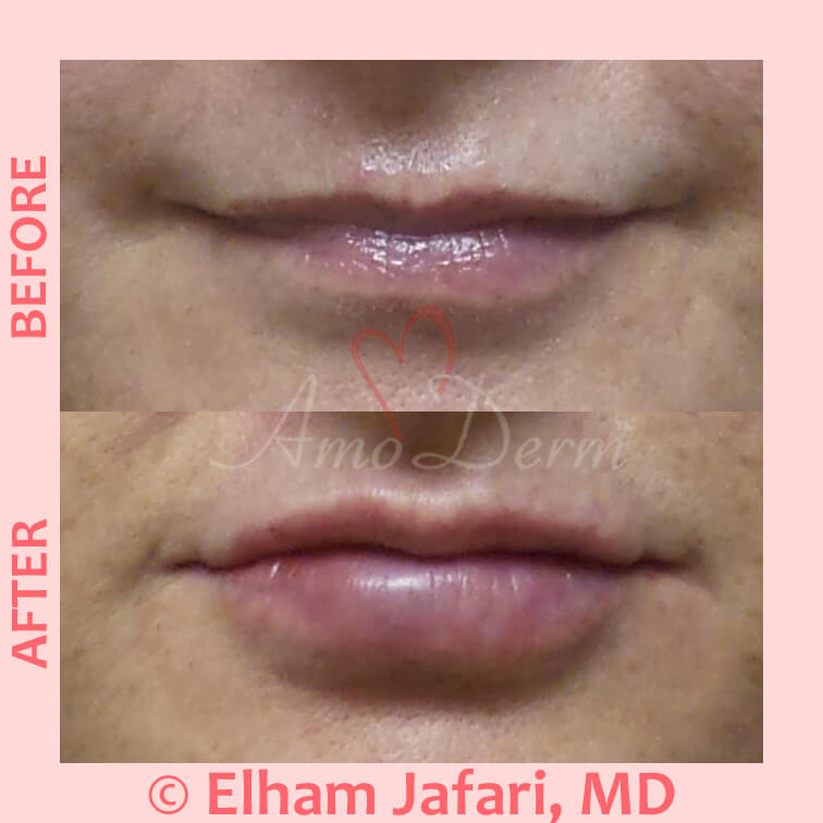 Lip Augmentation Irvine Lip Injections, Lip Fillers, Orange County