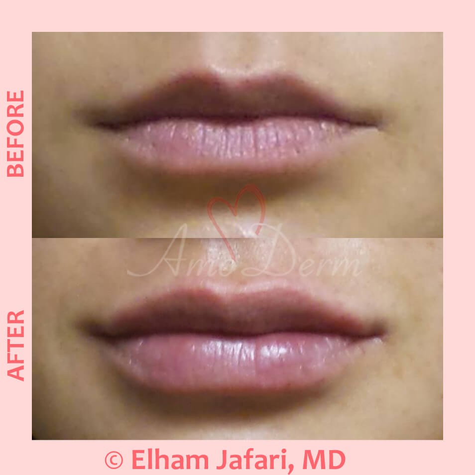 Lip Augmentation Irvine Lip Injections, Lip Fillers, Orange County