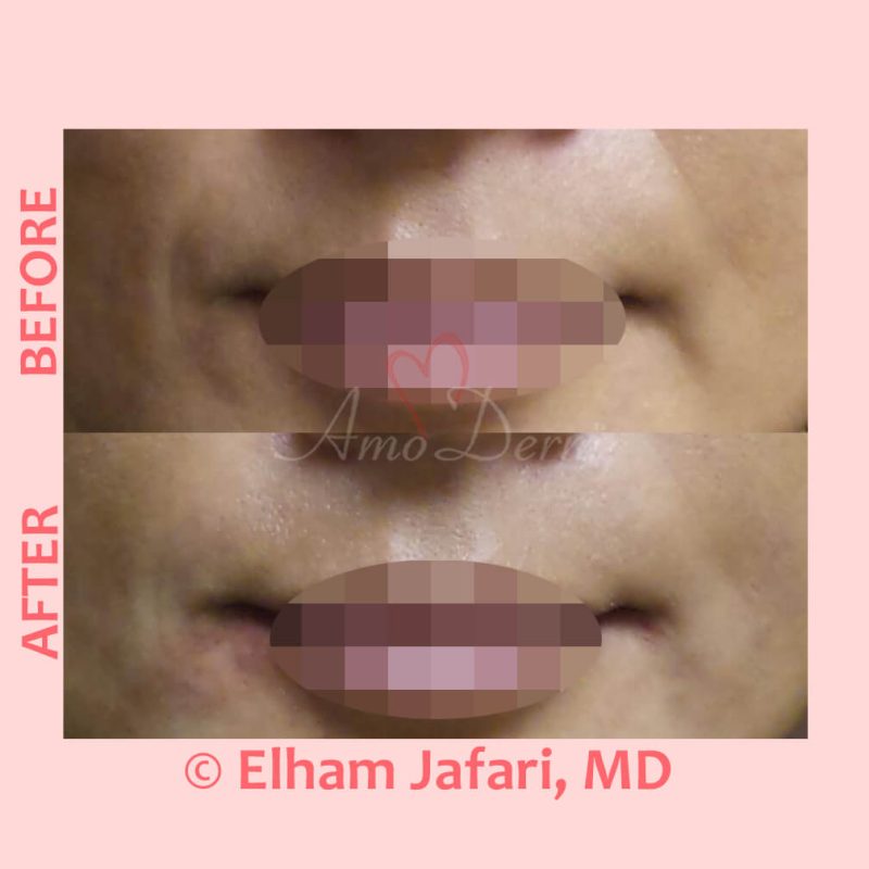 Treatment of nasolabial folds as part of non-surgical facelift
