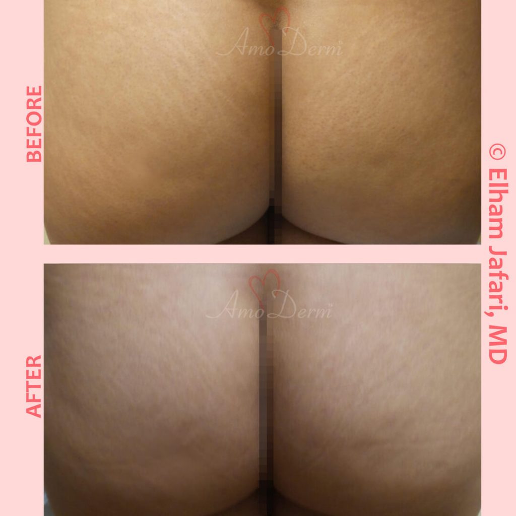 Treatment of stretch marks with Fractional CO2 laser (CO2 laser skin resurfacing)