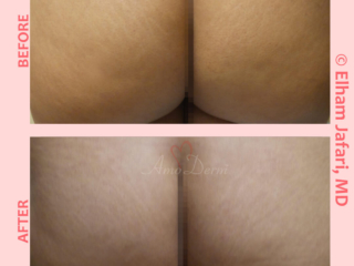 Treatment of stretch marks with Fractional CO2 laser (CO2 laser skin resurfacing)